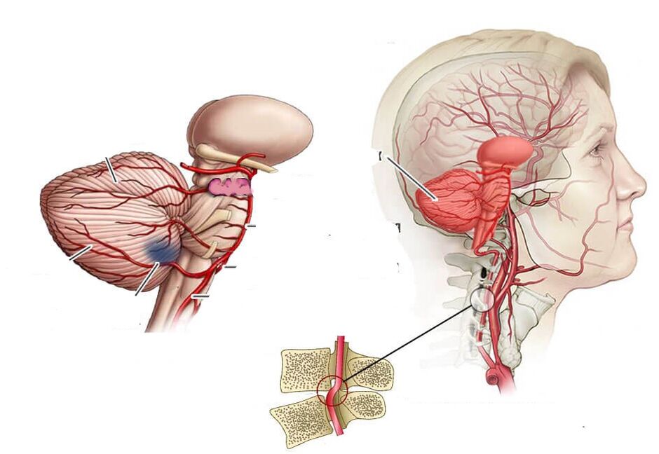 Serebellar Ischemia